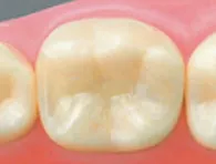 ハイブリッドセラミックインレー