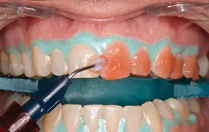 オフィスホワイトニング