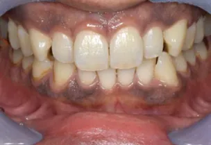 歯肉ピーリング